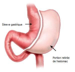 Sleeve-Gastrectomie