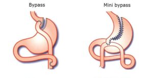 difference-bypass-mini-bypass