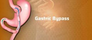 gastric-bypass